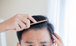 男士甩頭髮!M字額地中海脫髮原因+先兆及治療改善方法講解(2024更新)