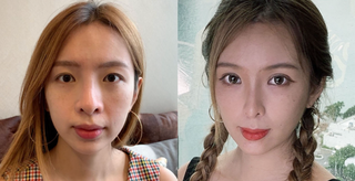 雙眼皮手術!雙眼皮要割還是縫?吊線好還是韓式釘書機式好?