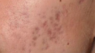 凹凸洞治療方法比較:分段式激光vs分段式射頻vs皮秒激光vs透明質酸+4大暗瘡印種類講解