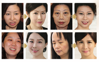 Restylane Lyft 長效透明質酸:塑造您的黃金分割美