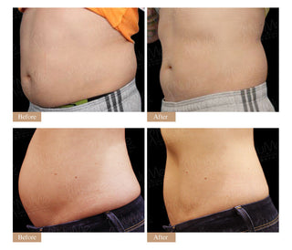 SculpSure® 脂肪分解激光溶脂