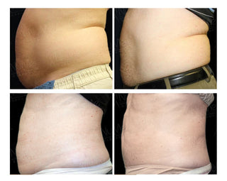 BTL Vanquish Me 標靶隔空溶脂診所版