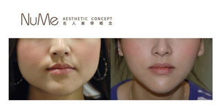 瘦面針療程 NEFERTITI瘦面秘技