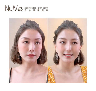 【更值得愛的顏值・鼻型是關鍵「香港鼻王」帶來最先進非入侵美鼻技術 】