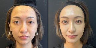 【千祈唔好割眼袋!傳統眼袋手術OUT!】