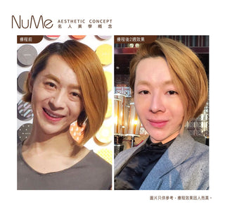 【千祈唔好割眼袋!傳統眼袋手術OUT!】