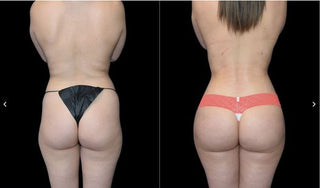 【全港首發!Renuvion apyx one超能電漿,讓肌膚緊緻到尖叫!】