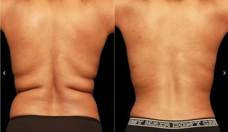 【全港首發!Renuvion apyx one超能電漿,讓肌膚緊緻到尖叫!】