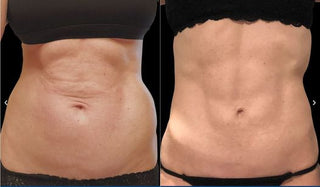 【全港首發!Renuvion apyx one超能電漿,讓肌膚緊緻到尖叫!】