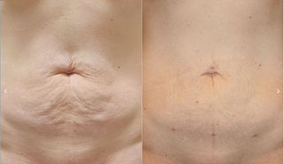 【全港首發!Renuvion apyx one超能電漿,讓肌膚緊緻到尖叫!】