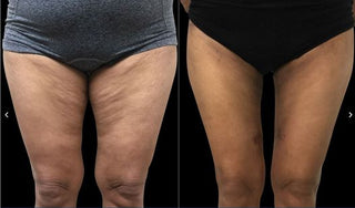 【全港首發!Renuvion apyx one超能電漿,讓肌膚緊緻到尖叫!】