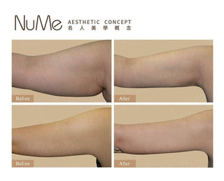 【即做即走抽脂】5大迷思破解!1天告別頑固脂肪!