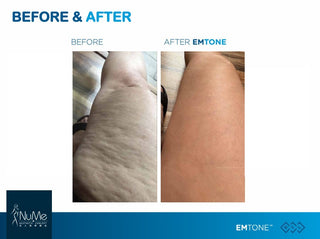 BTL Emtone 擊脂拉提