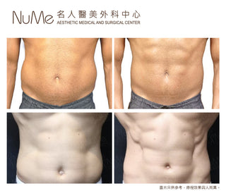 BTL Emsculpt Neo 增肌減脂
