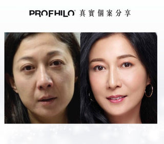 Profhilo 逆時針