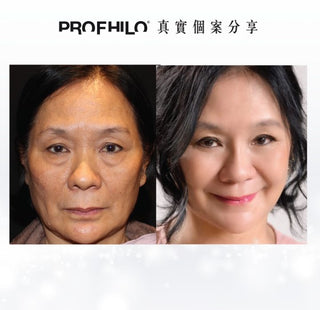 Profhilo 逆時針