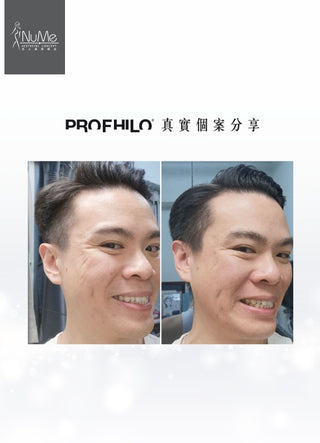 Profhilo 逆時針