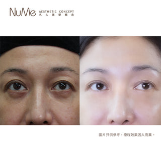 【千祈唔好割眼袋!傳統眼袋手術OUT!】