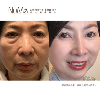 【千祈唔好割眼袋!傳統眼袋手術OUT!】