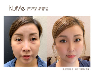 【千祈唔好割眼袋!傳統眼袋手術OUT!】