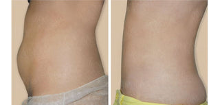 【即做即走抽脂】5大迷思破解!1天告別頑固脂肪!