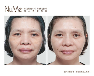 Restylane Vital Light® - 屬於頂級名媛的水光療程