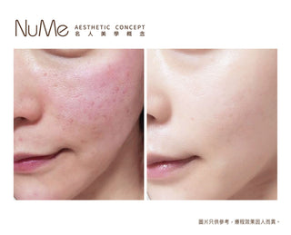 Restylane Vital Light® - 屬於頂級名媛的水光療程