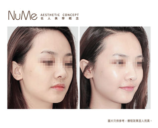 Restylane Vital Light® - 屬於頂級名媛的水光療程