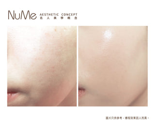 Restylane Vital Light® - 屬於頂級名媛的水光療程