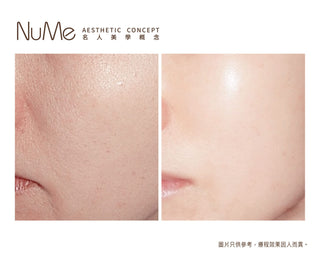 Restylane Vital Light® - 屬於頂級名媛的水光療程