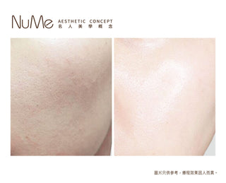 Restylane Vital Light® - 屬於頂級名媛的水光療程