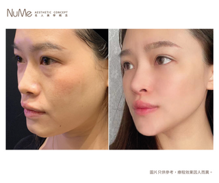 【顏值要升級・鼻型是關鍵「香港鼻王」帶來最先進非入侵美鼻技術 】