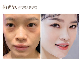 Scaffold 鼻基底埋線