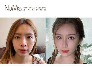 Scaffold 鼻基底埋線