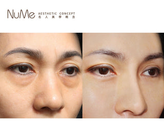 Scaffold 鼻基底埋線