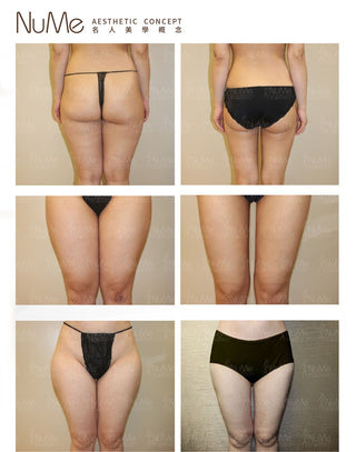 【即做即走抽脂】5大迷思破解!1天告別頑固脂肪!