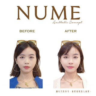 【不是每一對眼袋,都值得冒險】 —— 只有 NuMe 的「棉花棒法」,15 年來從未失手。