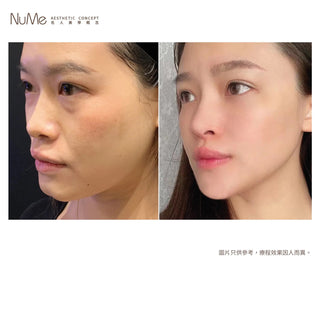 韓式 5D Hiko 美鼻埋線療程
