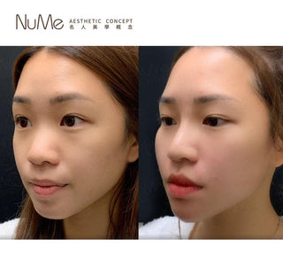 【更值得愛的顏值・鼻型是關鍵「香港鼻王」帶來最先進非入侵美鼻技術 】