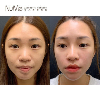 【顏值要升級・鼻型是關鍵「香港鼻王」帶來最先進非入侵美鼻技術 】