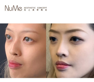韓式 4D Misko 美鼻頭療程