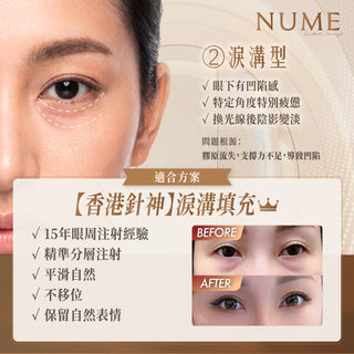 你以為自己有眼袋？其實，未必。｜高端眼周年輕感，從來不是填滿或抽走，而是判斷準確。