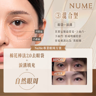 你以為自己有眼袋？其實，未必。｜高端眼周年輕感，從來不是填滿或抽走，而是判斷準確。