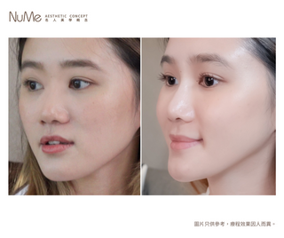 韓式 5D Hiko 美鼻埋線療程
