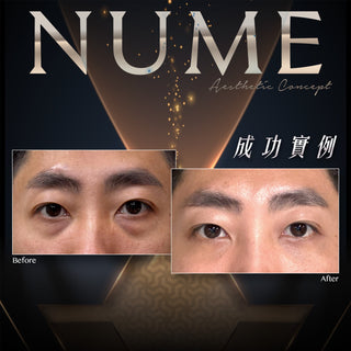 從吳綺莉到上萬名真實案例，去眼袋真正的價值，是 10 年後依然自然、平滑。