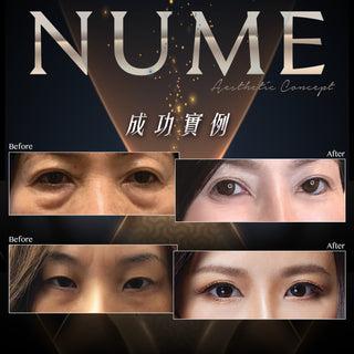 從吳綺莉到上萬名真實案例，去眼袋真正的價值，是 10 年後依然自然、平滑。