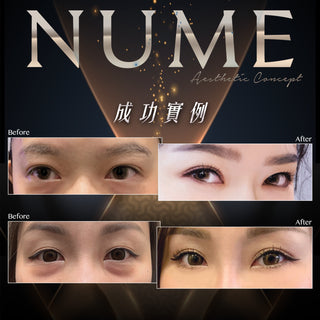 從吳綺莉到上萬名真實案例，去眼袋真正的價值，是 10 年後依然自然、平滑。